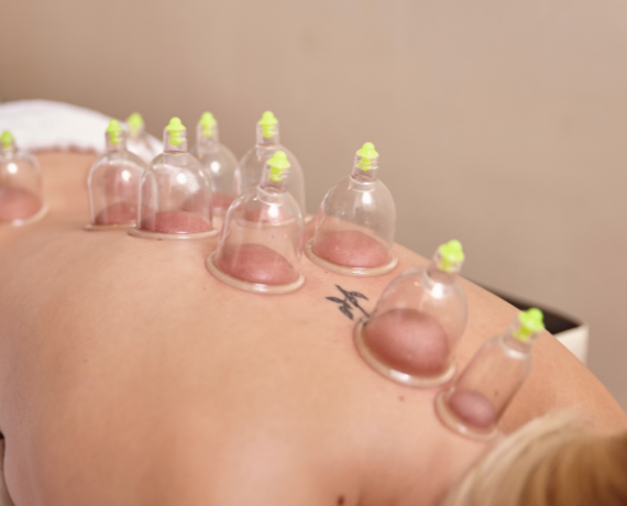 cupping.png